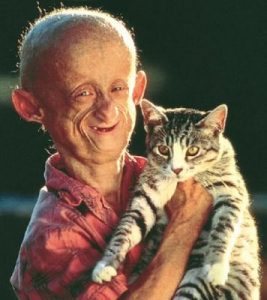 bolest-3-progeria